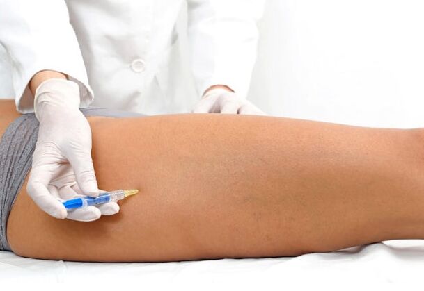 Varicose veins