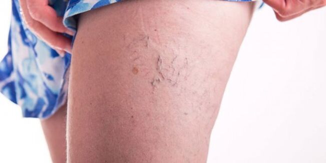 varicose veins