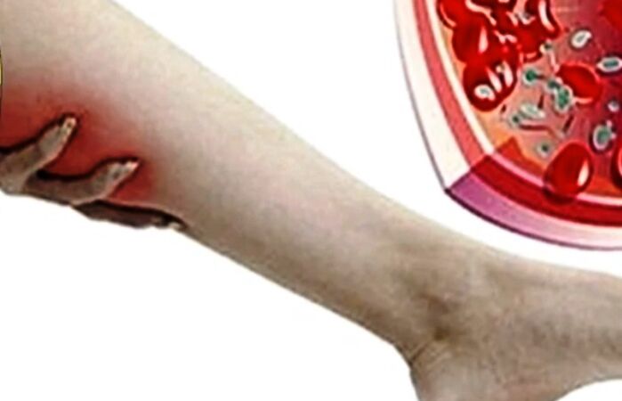 Varicose veins