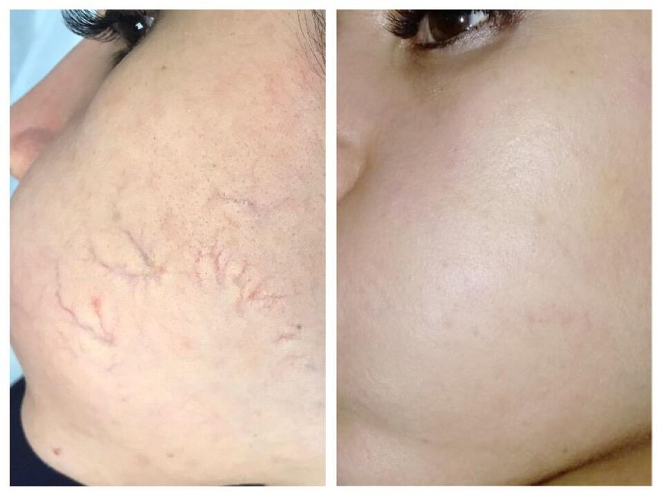 Different veins