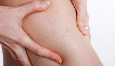 How are varicose veins on the legs