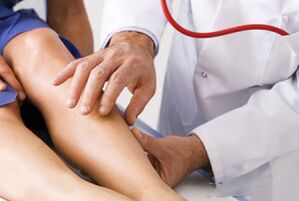 Varicose veins