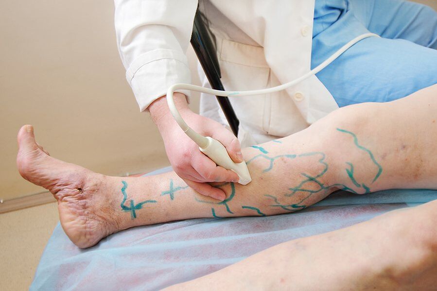 Preparation for miniphlebectomy - marking the perforators on the leg, performing an ultrasound scan
