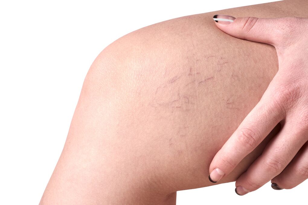 Stage C1 – spider veins