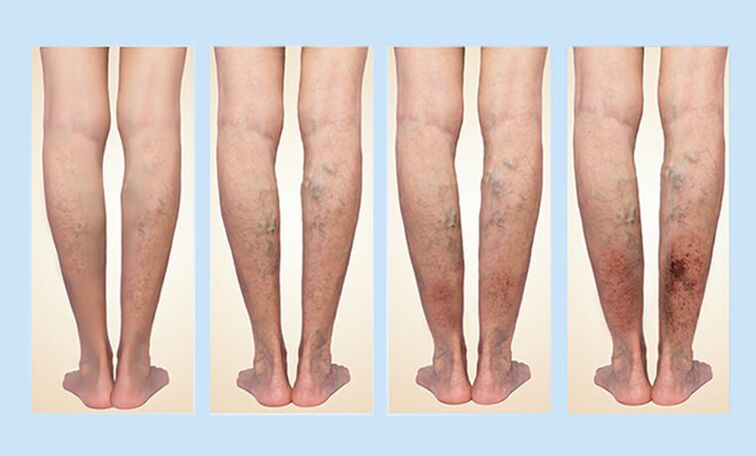 Stages of varicose veins